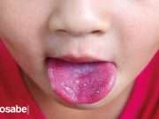 ¿Qué es el Síndrome de Kawasaki? Síndrome de Kawasaki qué es