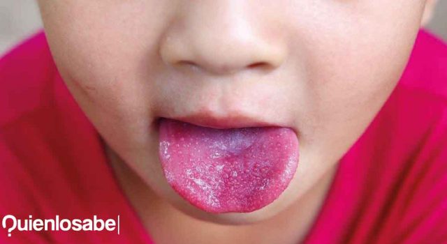 ¿Qué es el Síndrome de Kawasaki? Síndrome de Kawasaki qué es