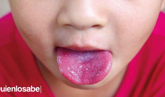 Síndrome de Kawasaki qué es