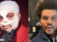 The Weeknd cirugía
