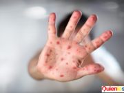 El Sarampión esta causando alerta a la Organización Mundial de la Salud.